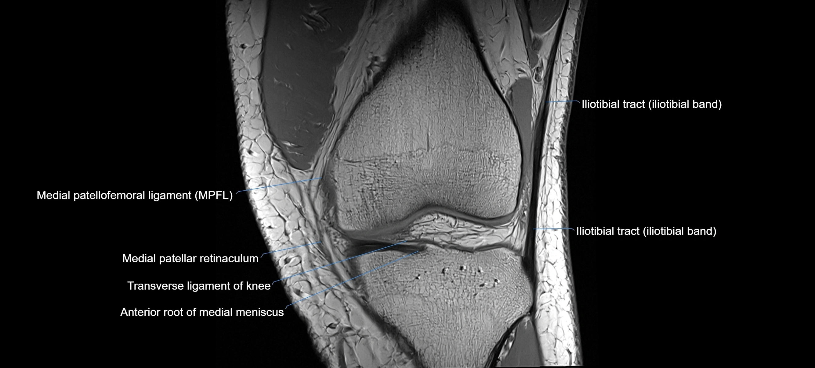 MRI coronal  ligaments cross sectional anatomy 3T  radiology  image-img-04001-00014.webp